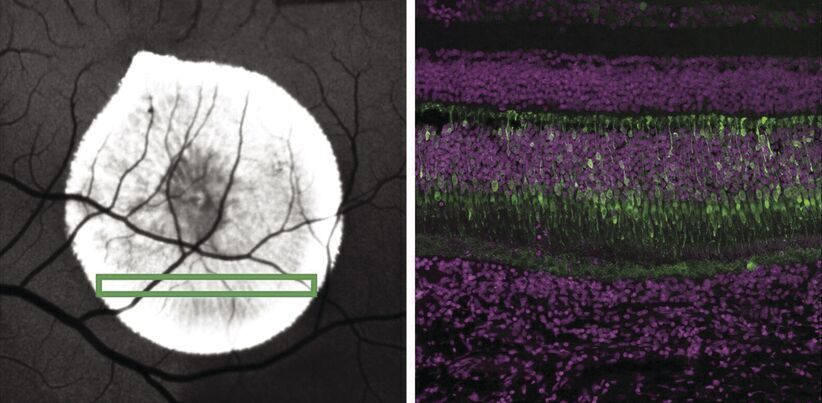 Researchers closing in on genetic treatments for hereditary lung disease, vision loss
