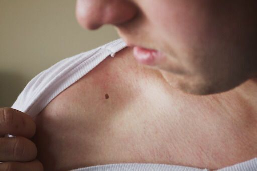 Melanoma patients respond to immunotherapy after changes to gut microbiome
