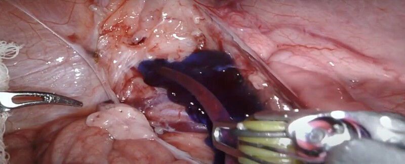 Oregon State University research finds solution to common surgical problem of nerve damage